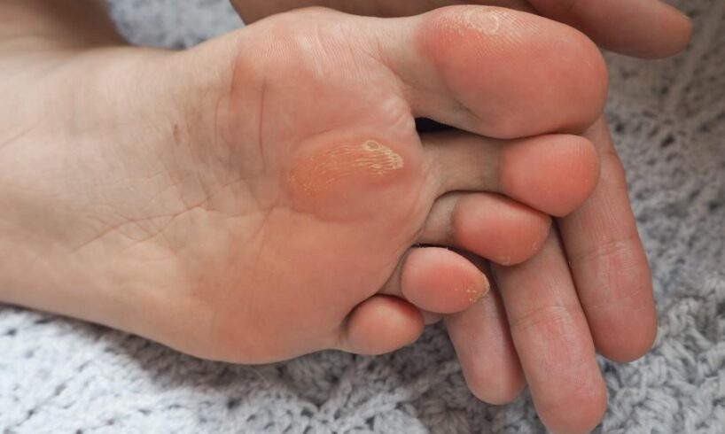 callus